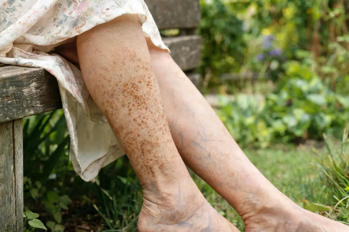 Lower legs of a woman in her seventies on a garden bench, with patchy rust-brown speckled staining on the shin